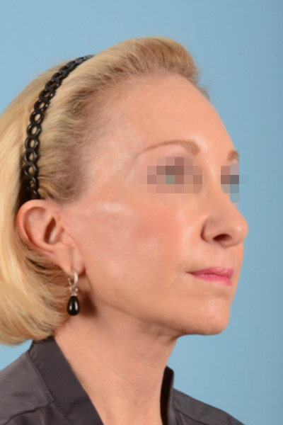 Facelift Before & After Gallery - Patient 10380596 - Image 6