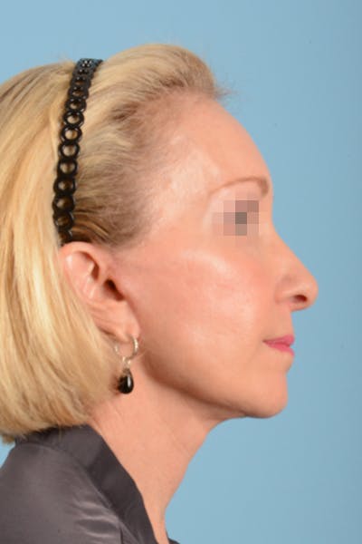 Facelift Before & After Gallery - Patient 10380596 - Image 8