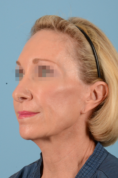 Facelift Before & After Gallery - Patient 10380596 - Image 9