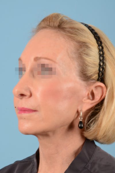 Facelift Before & After Gallery - Patient 10380596 - Image 10