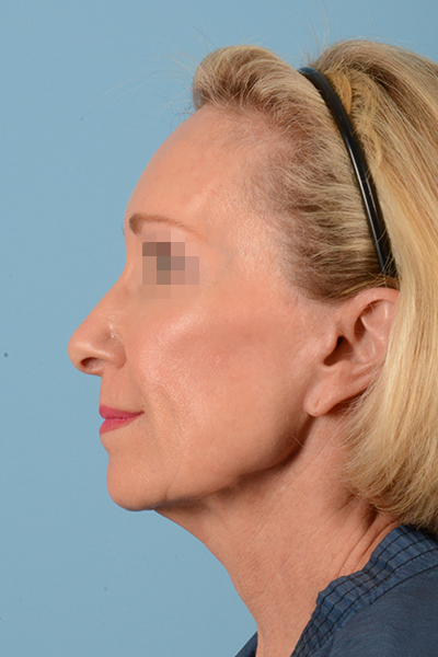 Facelift Before & After Gallery - Patient 10380596 - Image 11