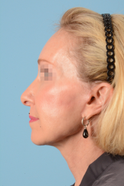 Facelift Before & After Gallery - Patient 10380596 - Image 12