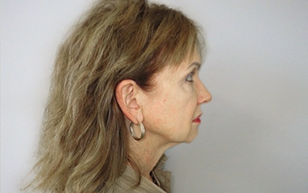 Neck Lift