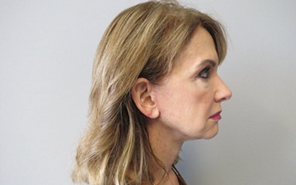 Neck Lift