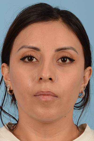 Rhinoplasty Before & After Gallery - Patient 10380606 - Image 3