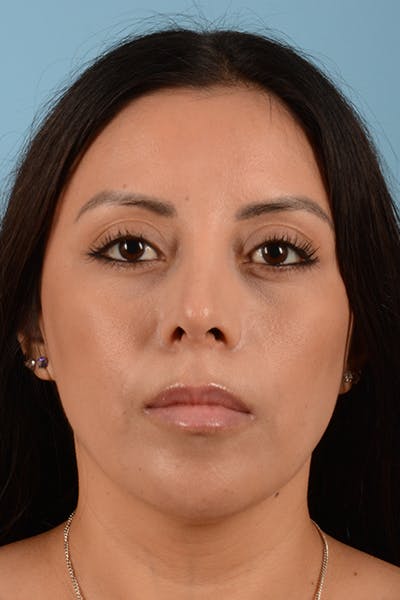 Rhinoplasty Before & After Gallery - Patient 10380606 - Image 4