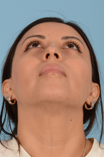 Rhinoplasty Before & After Gallery - Patient 10380606 - Image 7
