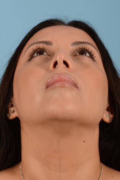 Rhinoplasty Before & After Gallery - Patient 10380606 - Image 8