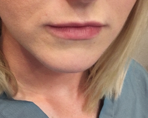 Lip Fillers Before & After Gallery - Patient 10380728 - Image 1