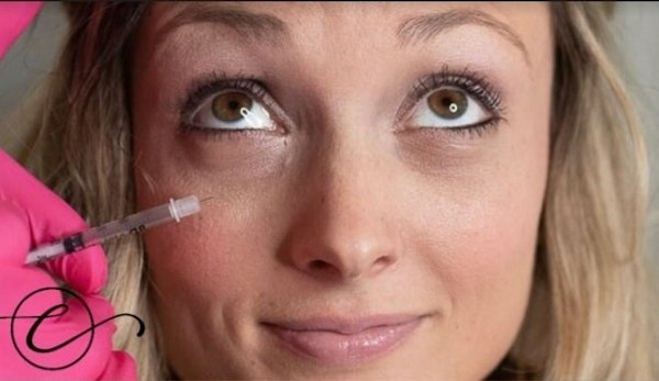 Dermal Fillers