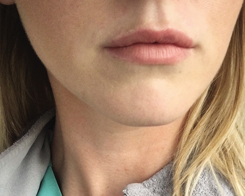 Lip Fillers Before & After Gallery - Patient 10380728 - Image 2