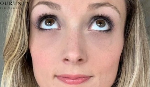 Dermal Fillers