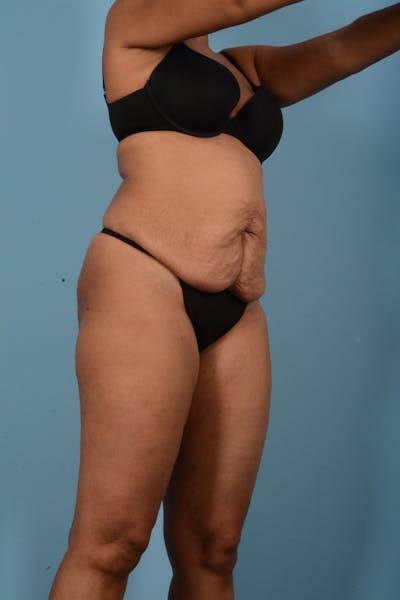 Tummy Tuck Before & After Gallery - Patient 11203331 - Image 3
