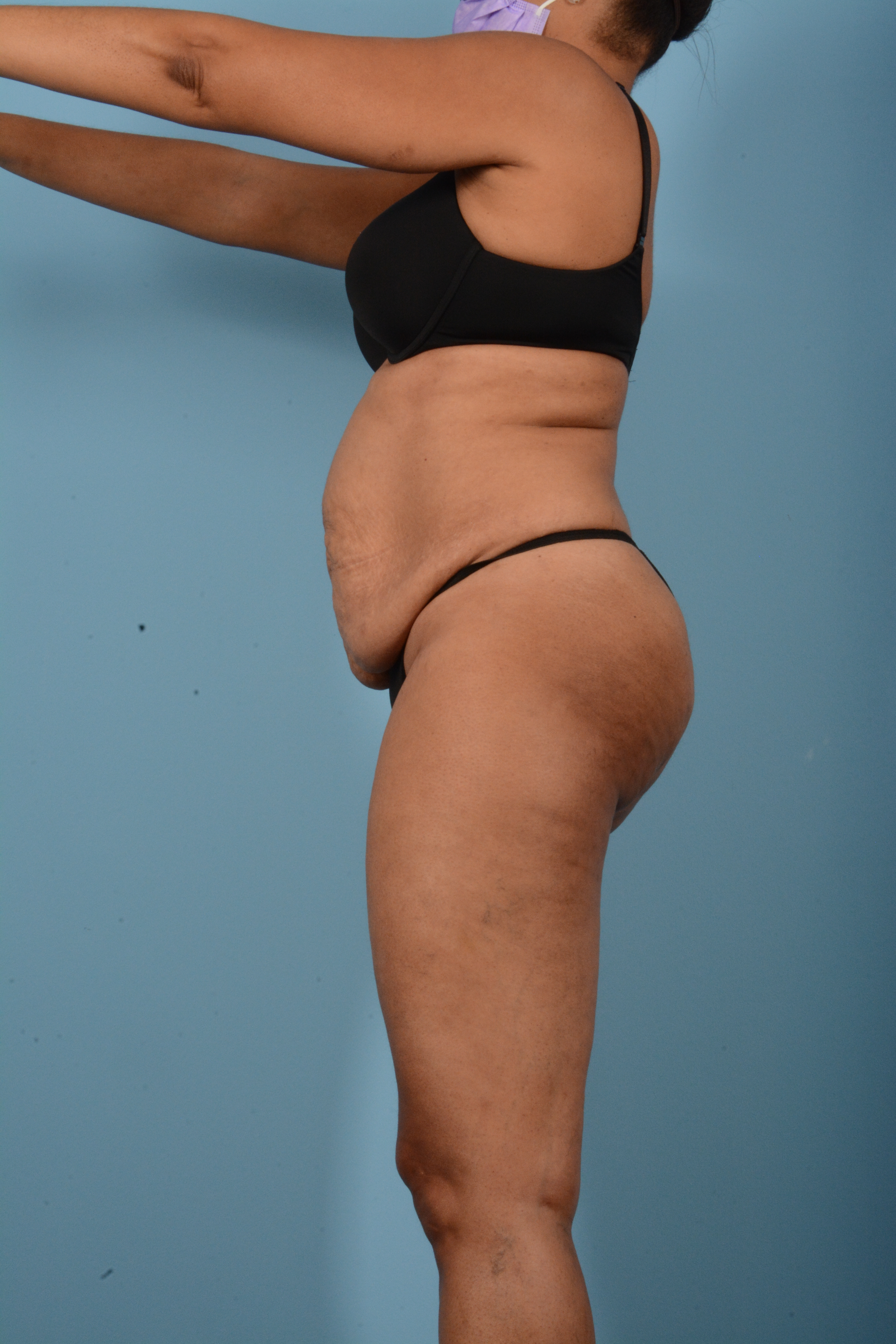 Tummy Tuck (Abdominoplasty)  Before & After Gallery - Patient 11203331 - Image 9