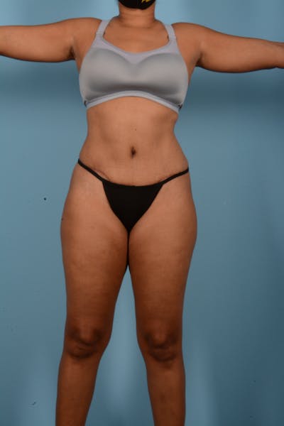 Tummy Tuck (Abdominoplasty)  Before & After Gallery - Patient 11203331 - Image 2
