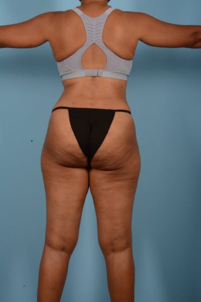 Tummy Tuck (Abdominoplasty)  Before & After Gallery - Patient 11203331 - Image 12