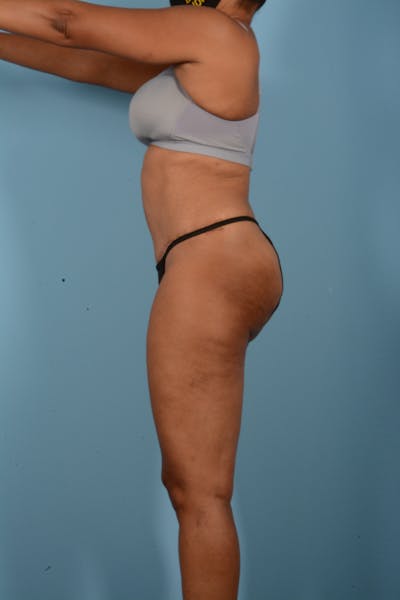 Tummy Tuck Before & After Gallery - Patient 11203331 - Image 10