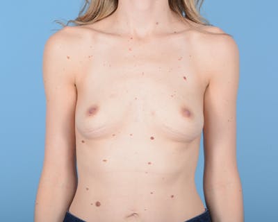 Breast Augmentation Before & After Gallery - Patient 10380360 - Image 1