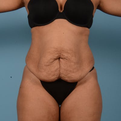 Liposuction Before & After Gallery - Patient 18113318 - Image 1