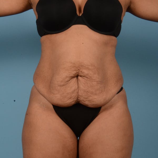 Liposuction Before & After Gallery - Patient 18113318 - Image 1