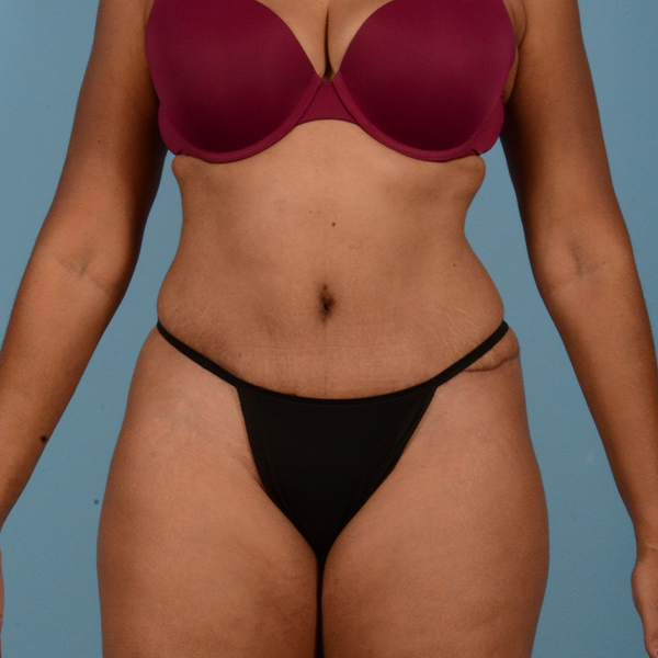 Liposuction Before & After Gallery - Patient 18113318 - Image 2