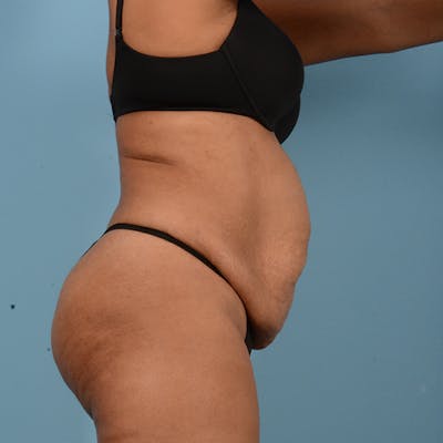 Liposuction Before & After Gallery - Patient 18113318 - Image 3