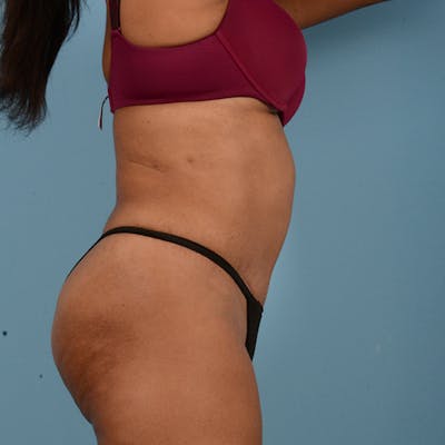 Liposuction Before & After Gallery - Patient 18113318 - Image 4