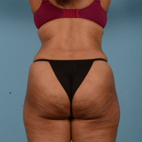 Liposuction Gallery - Patient 18113318 - Image 6