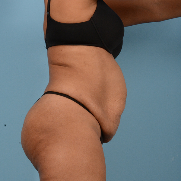 Tummy Tuck (Abdominoplasty)  Before & After Gallery - Patient 18113344 - Image 3