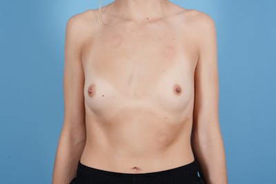Breast Augmentation Before & After Gallery - Patient 18426852 - Image 1