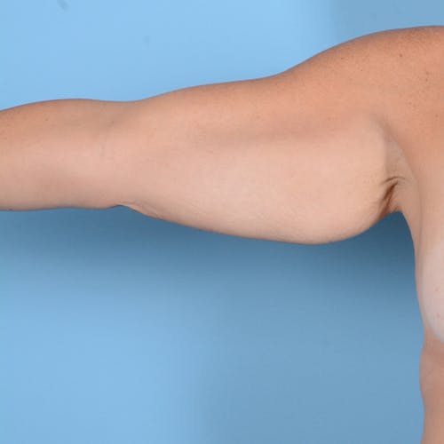 Armlift (Brachioplasty) Before & After Gallery - Patient 24221307 - Image 1