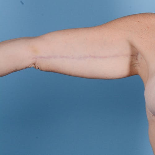 Armlift (Brachioplasty) Before & After Gallery - Patient 24221307 - Image 2