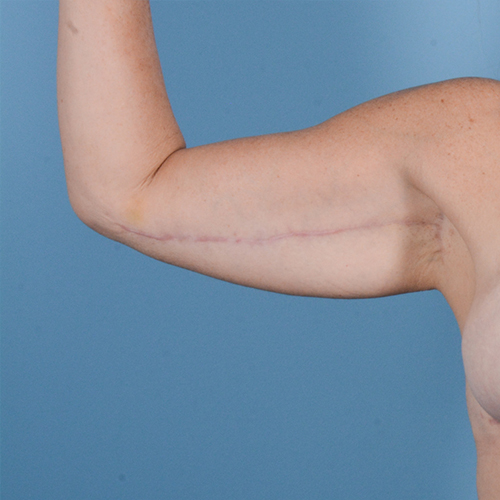 Armlift (Brachioplasty) Before & After Gallery - Patient 24221307 - Image 4