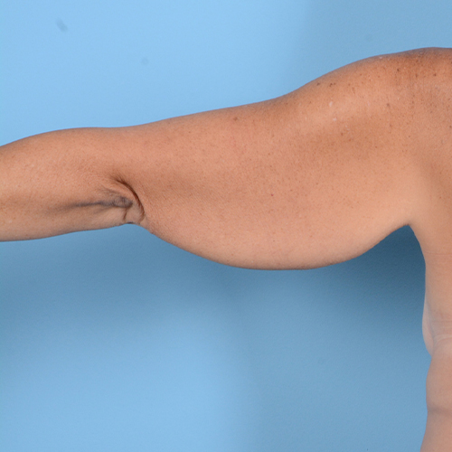 Armlift (Brachioplasty) Before & After Gallery - Patient 24221307 - Image 5