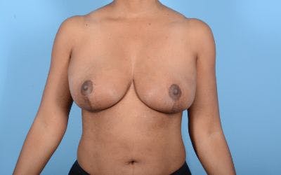 Breast Reduction with Lift Before & After Gallery - Patient 24923342 - Image 2