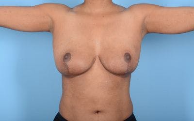 Breast Reduction with Lift Before & After Gallery - Patient 24923342 - Image 4