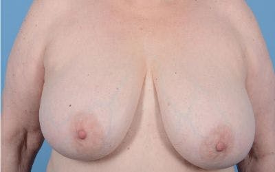 Breast Reduction with Lift Before & After Gallery - Patient 24924260 - Image 1