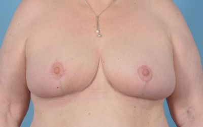 Breast Reduction with Lift Before & After Gallery - Patient 24924260 - Image 2