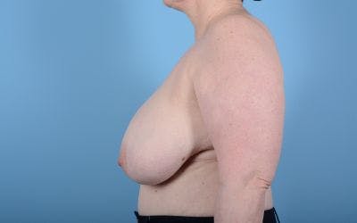 Breast Reduction with Lift Before & After Gallery - Patient 24924260 - Image 3