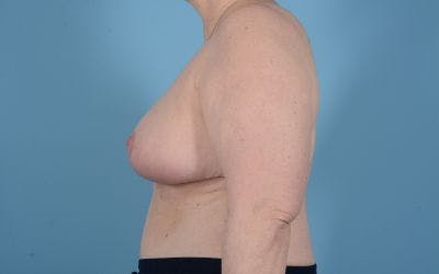 Breast Reduction with Lift Before & After Gallery - Patient 24924260 - Image 4