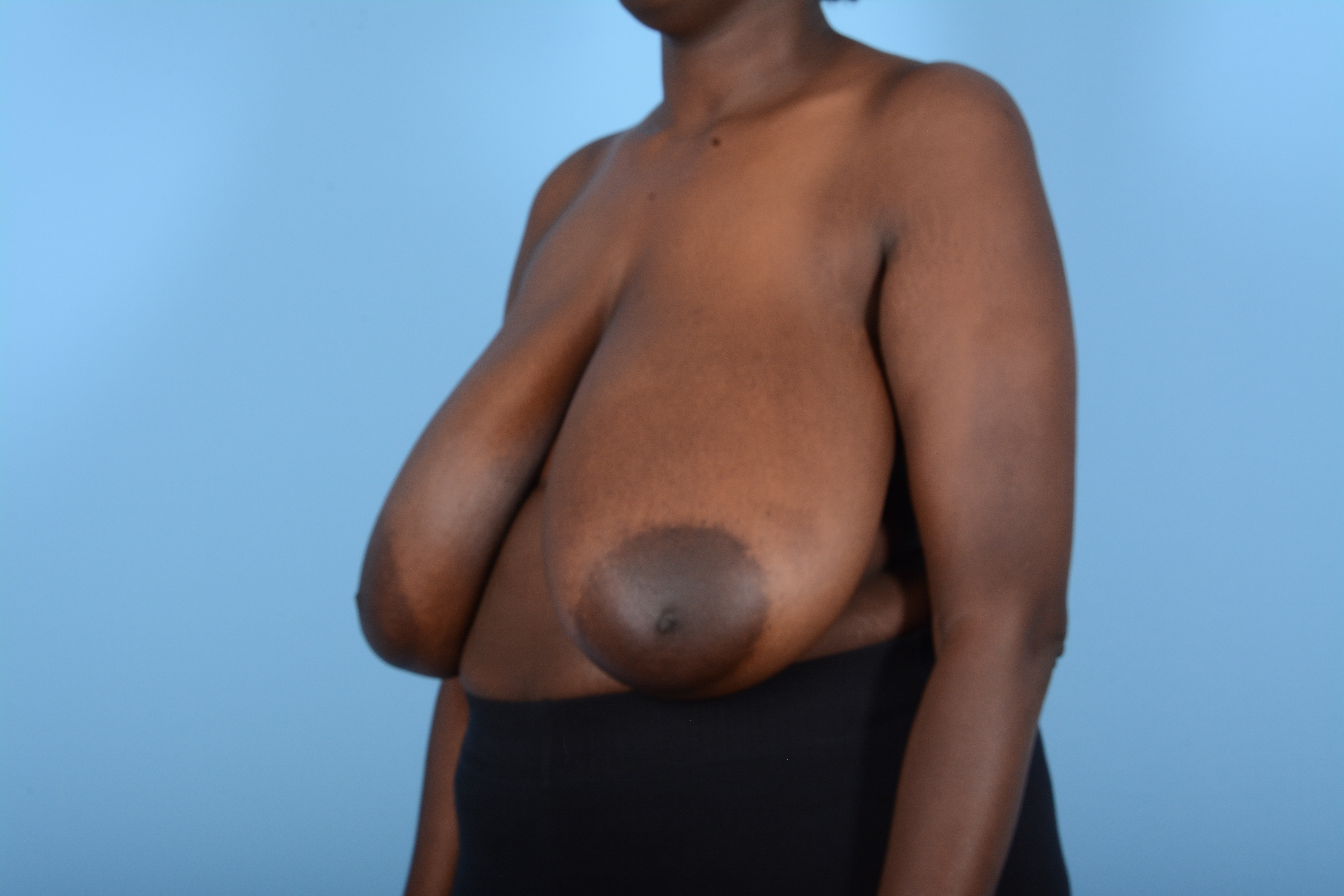 Breast Reduction with Lift Before & After Gallery - Patient 24924328 - Image 3