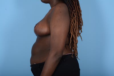 Breast Reduction with Lift Before & After Gallery - Patient 24924328 - Image 6