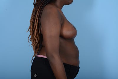 Breast Reduction with Lift Before & After Gallery - Patient 24924328 - Image 8