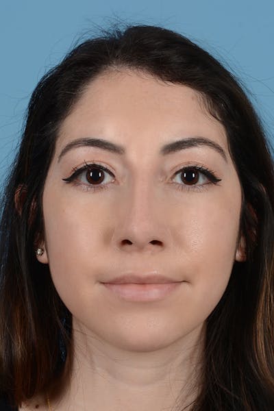 Rhinoplasty Before & After Gallery - Patient 31223238 - Image 4