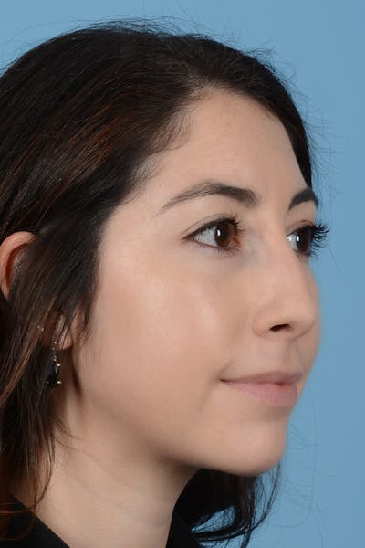 Rhinoplasty Before & After Gallery - Patient 31223238 - Image 3