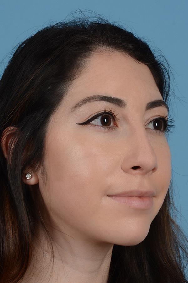 Rhinoplasty Before & After Gallery - Patient 31223238 - Image 4