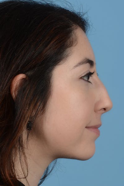 Rhinoplasty Before & After Gallery - Patient 31223238 - Image 1