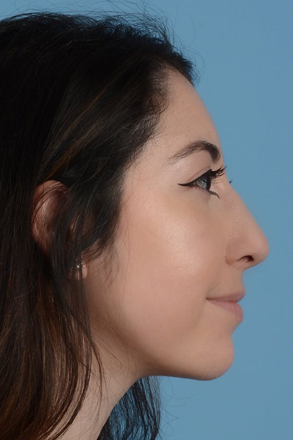 Rhinoplasty Before & After Gallery - Patient 31223238 - Image 2