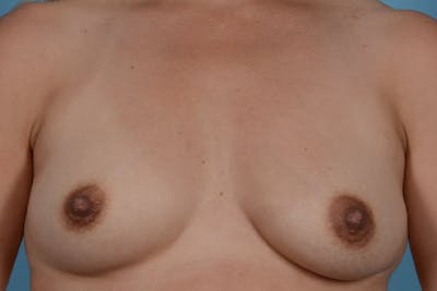 Breast Augmentation Before & After Gallery - Patient 31926713 - Image 1