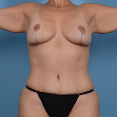 Tummy Tuck (Abdominoplasty)  Before & After Gallery - Patient 37534948 - Image 2